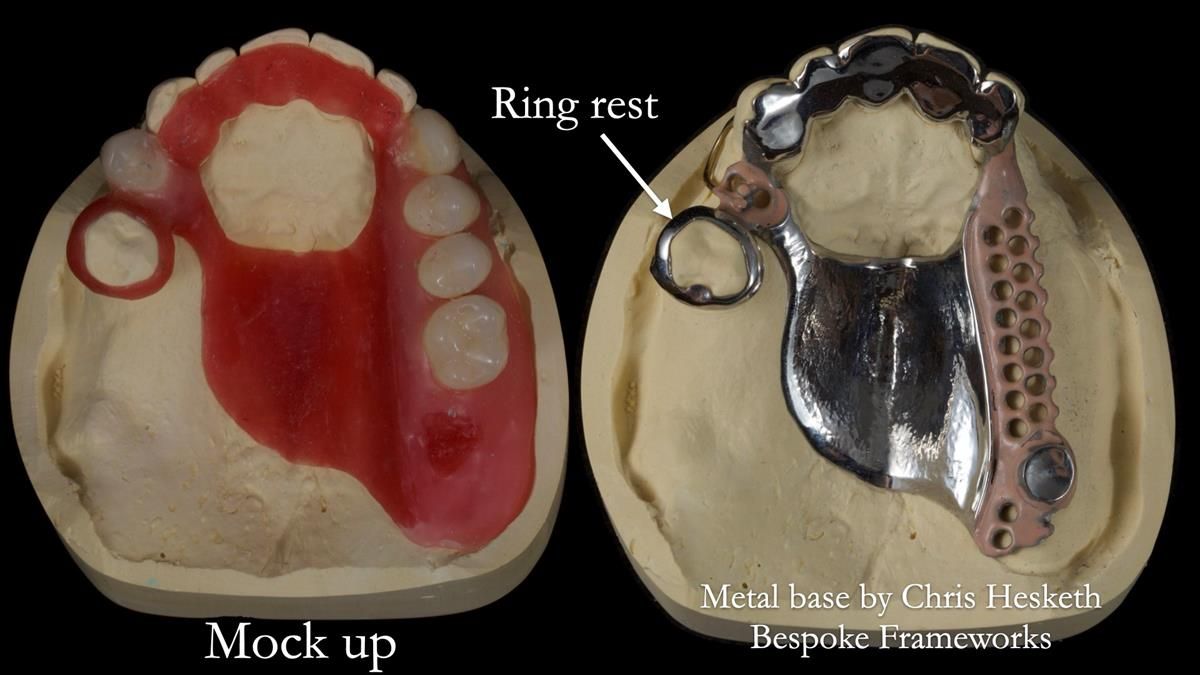 Newsletter 89 – Simon: A Challenging Kennedy Class II Division 1 Upper CoCr Partial Denture with a High Smile Line