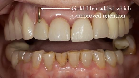 Newsletter 51 Managing Anne’s failing dentition with distal extension base RPD/Splint FULL PROTOCOL