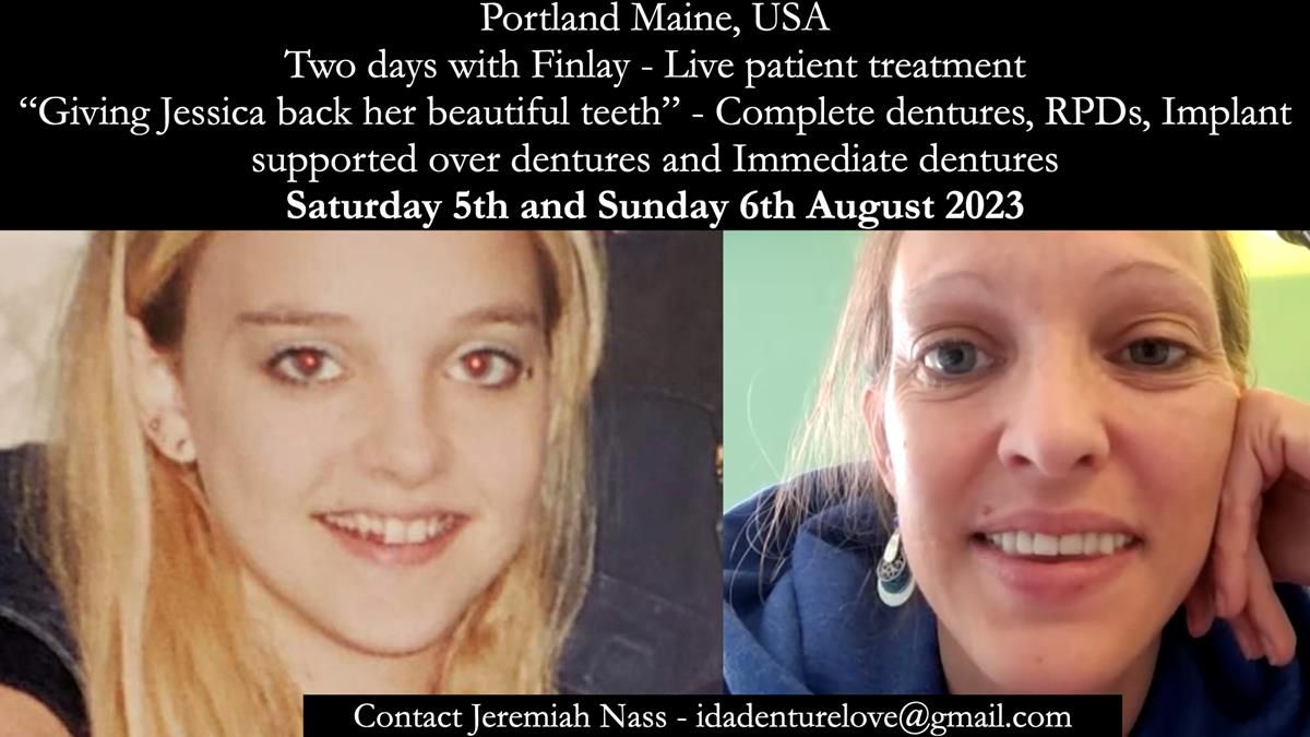 Newsletter 52 Managing Jo’s failing dentition with extractions and Mk 1/Mk 2 complete upper dentures and lower partial dentures FULL PROTOCOL