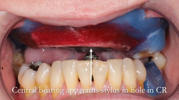 Finlay's Newsletter 58 Gasket upper partial denture for Zoe