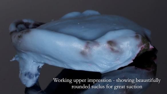 Newsletter 83: Sheila’s Complete Denture Success