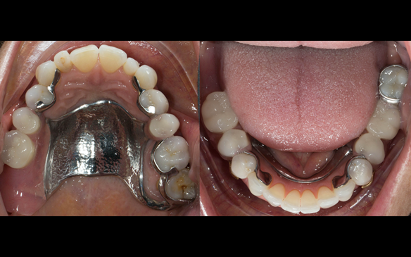 Figure 83 Definitive dentures fitted 9 months after extractions