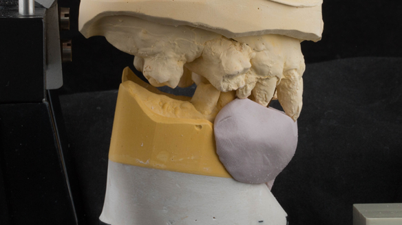 Figure 26 Mounted casts for Mk 1 denture. Silicone index used as a guide for positioning denture teeth