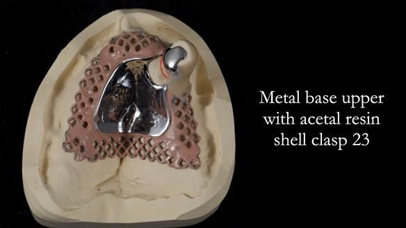 Newsletter 55 Provision of metal based partial dentures for Zephyrine with a repaired cleft lip and palate