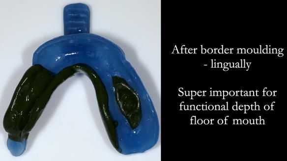 Finlay's Newsletter 61 provision of a lower unilateral free end saddle metal based partial denture for Joyce