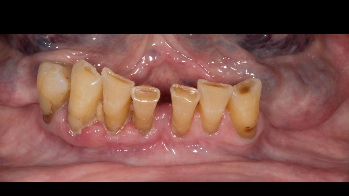 Newsletter 87 – Father Peter: A Partial Denture that needed Minor Miracle