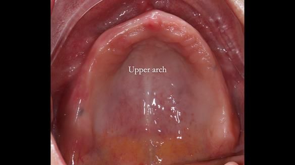 Newsletter 82 Mary - A complete upper and a one-tooth gasket denture