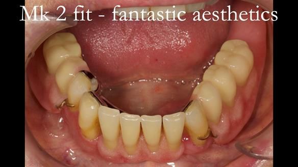 Finlay's Case Study Newsletter 40 - Immediate Mk 1 RPD to Definitive Mk 2 RPD - full protocol