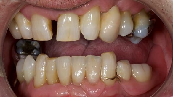 Newsletter 86 Peter the Architect — precision removable partial dentures case study