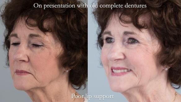 Newsletter 75: Marion’s case - Step-by-step complete denture workflow