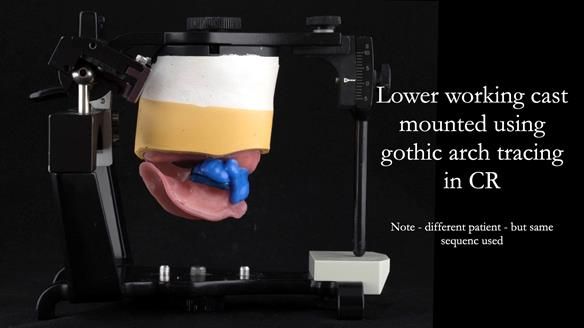 The wax rim is removed and the central bearing apparatus is fitted to the upper work cast.