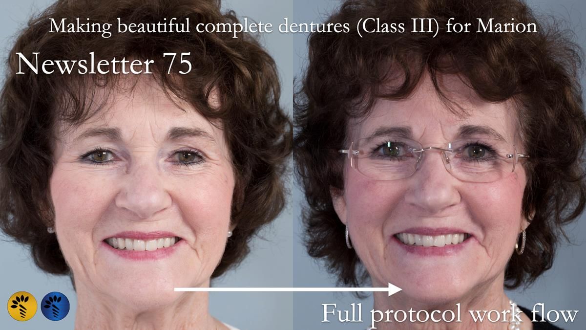 Newsletter 75: Marion’s case - Step-by-step complete denture workflow