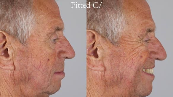 Newsletter 54 case presentation upper complete denture and lower Scandinavian designed hygienic partial denture for David