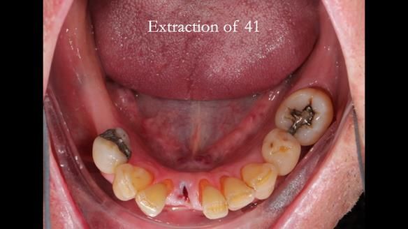 Newsletter 54 case presentation upper complete denture and lower Scandinavian designed hygienic partial denture for David