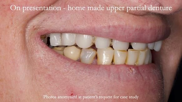 Newsletter 52 Managing Jo’s failing dentition with extractions and Mk 1/Mk 2 complete upper dentures and lower partial dentures FULL PROTOCOL