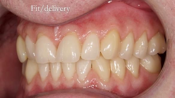Newsletter 57 showcases the making and fitting process of implant-supported complete dentures for Alisdair