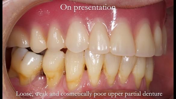 Finlay's Newsletter 58 Gasket upper partial denture for Zoe