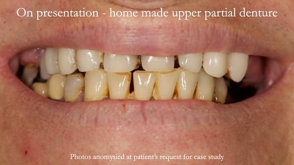 Newsletter 52 Managing Jo’s failing dentition with extractions and Mk 1/Mk 2 complete upper dentures and lower partial dentures FULL PROTOCOL
