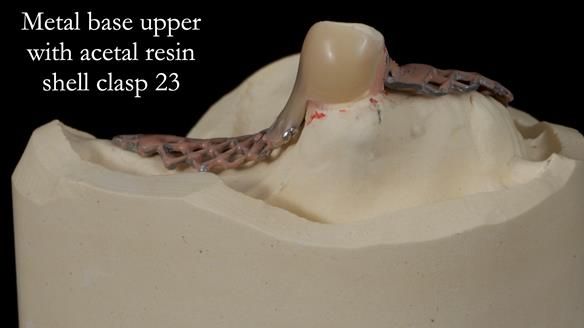 Newsletter 55 Provision of metal based partial dentures for Zephyrine with a repaired cleft lip and palate