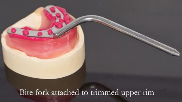 Complete denture Class II div 2 deep overbite Newsletter 39