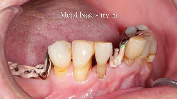 Newsletter 54 case presentation upper complete denture and lower Scandinavian designed hygienic partial denture for David