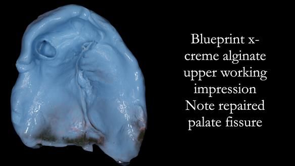 Newsletter 55 Provision of metal based partial dentures for Zephyrine with a repaired cleft lip and palate