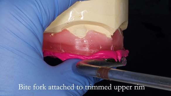 Newsletter 77: Jeremy’s case – immediate complete upper denture