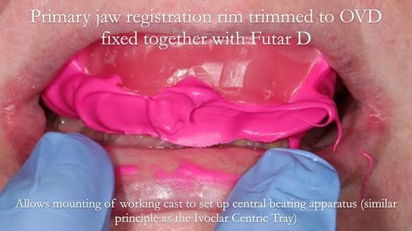 Finlay's Newsletter 58 Gasket upper partial denture for Zoe