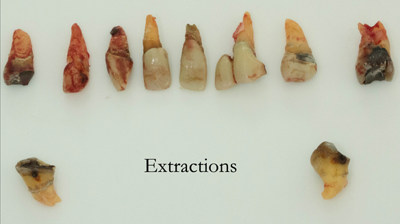 Figure 32 Extracted teeth
