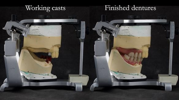 Newsletter 76: Jackie’s case – Telescopic overdenture & precision RPD (the tricky truth!)
