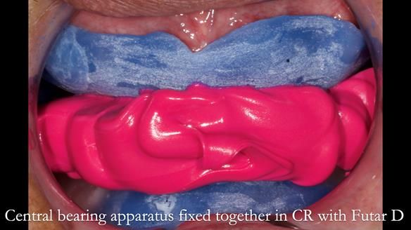 Finlay's Newsletter 62 provision of extractions and metal based complete dentures for Rafique