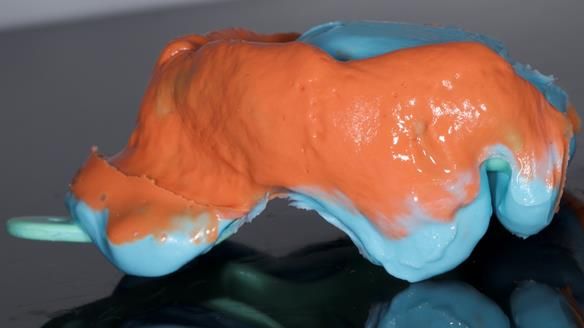 Newsletter 82 Mary - A complete upper and a one-tooth gasket denture