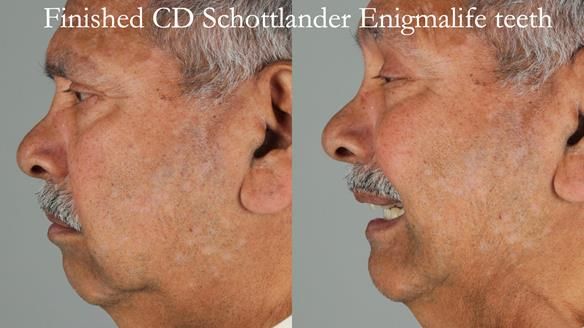 Finlay's Newsletter 62 provision of extractions and metal based complete dentures for Rafique