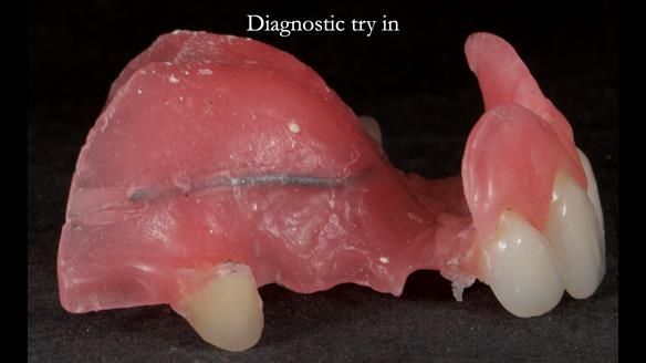 Newsletter 81 - Pam’s Story — how a partial denture changed her life (+ live walkthrough this Thursday)