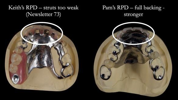 Newsletter 81 - Pam’s Story — how a partial denture changed her life (+ live walkthrough this Thursday)