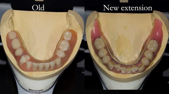 Complete denture Class II div 2 deep overbite Newsletter 39
