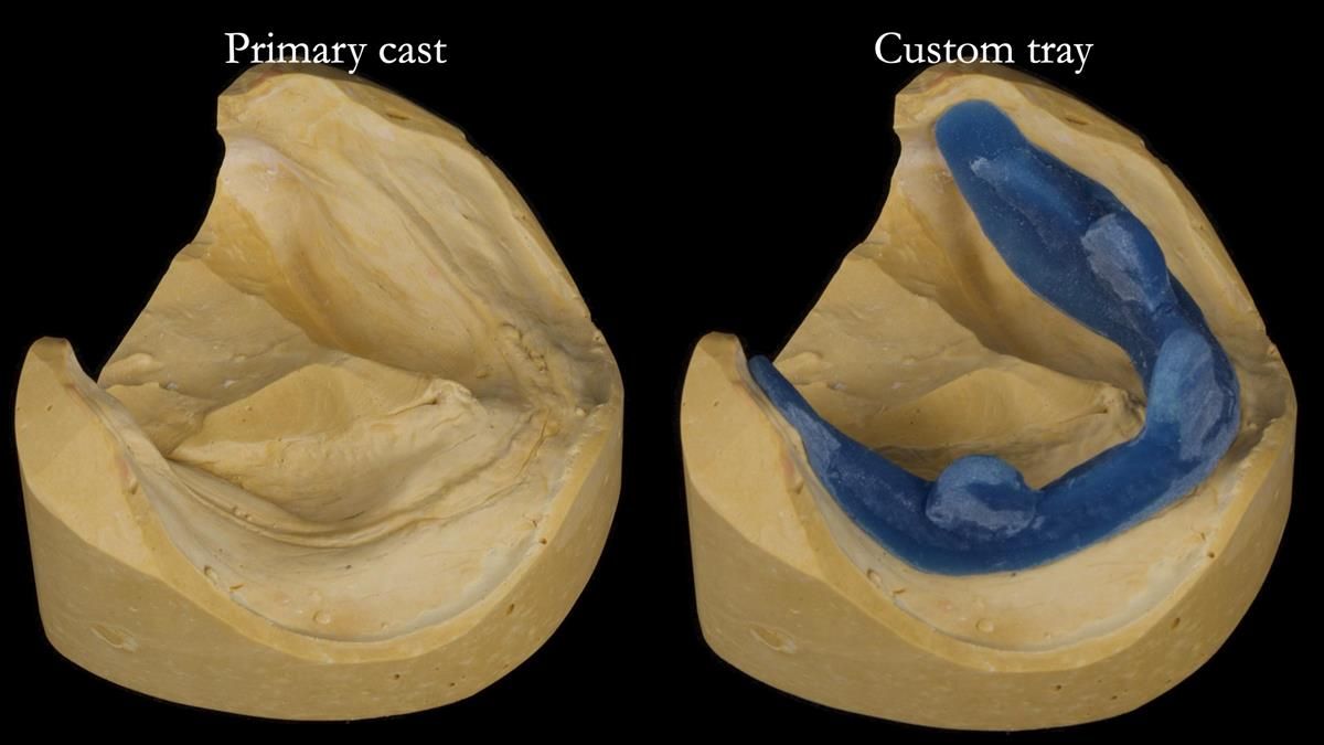 Fin’s Newsletter 88 — Complete dentures - full protocol… he rearranged his own teeth!