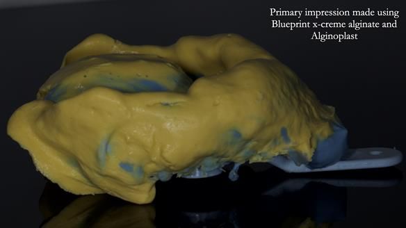 Newsletter 81 - Pam’s Story — how a partial denture changed her life (+ live walkthrough this Thursday)