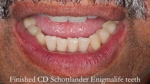 Finlay's Newsletter 62 provision of extractions and metal based complete dentures for Rafique