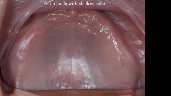 Newsletter 83: Sheila’s Complete Denture Success