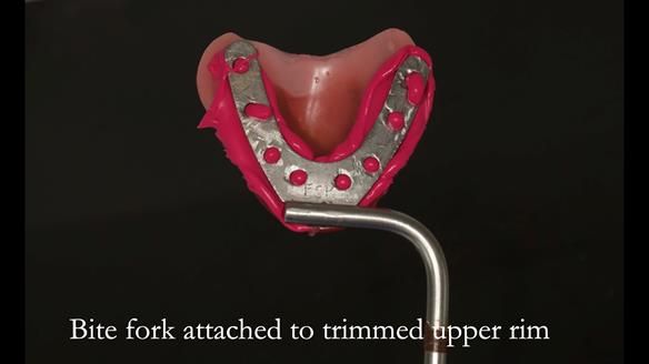 Newsletter 54 case presentation upper complete denture and lower Scandinavian designed hygienic partial denture for David