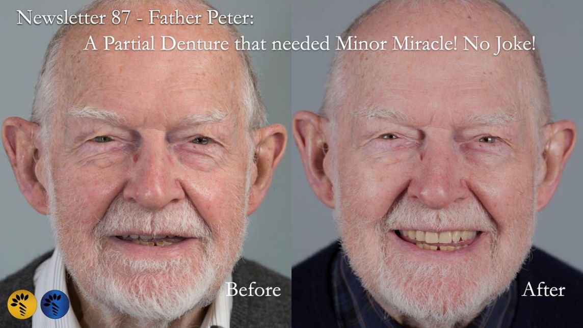 Newsletter 87 – Father Peter: A Partial Denture that needed Minor Miracle