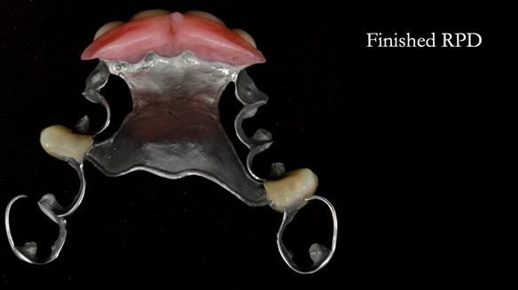 Newsletter 81 - Pam’s Story — how a partial denture changed her life (+ live walkthrough this Thursday)