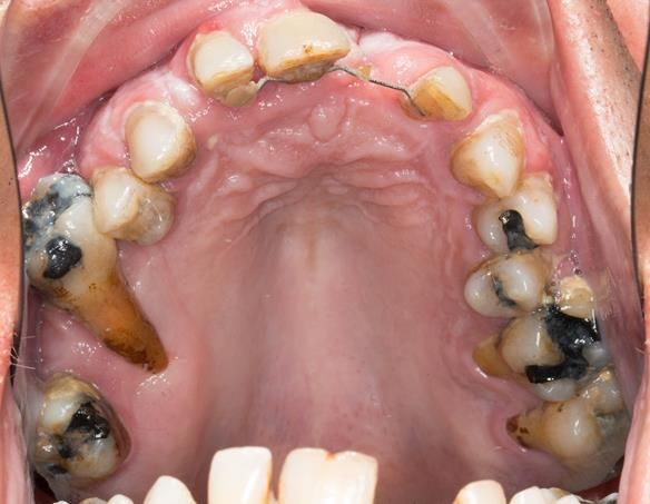 Figure 9 Pre-treatment occlusal view of upper teeth