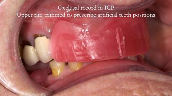 Eileen's transformation with upper and lower RPDs of Scandinavian hygienic design FULL PROTOCOL