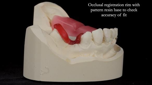 Newsletter 55 Provision of metal based partial dentures for Zephyrine with a repaired cleft lip and palate