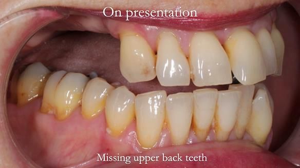 Newsletter 56 showing the making and fitting of a bilateral free end saddle upper removable partial denture (RPD) for patient with pemphigus