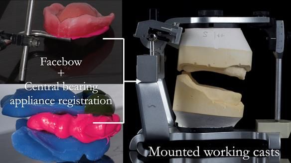 Newsletter 53 showing the making and fitting of ultra life-like dentures for Valena