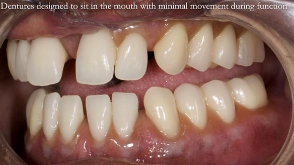 Newsletter 53 showing the making and fitting of ultra life-like dentures for Valena