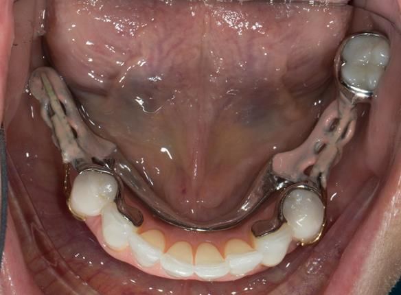 Figure 74 Cobalt chromium framework trial insertion, checking the fit onto the natural teeth and soft tissues